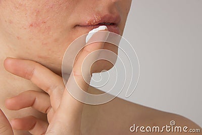 Herpes with pus on the lips of a young girl and pimples on the f Stock Photo