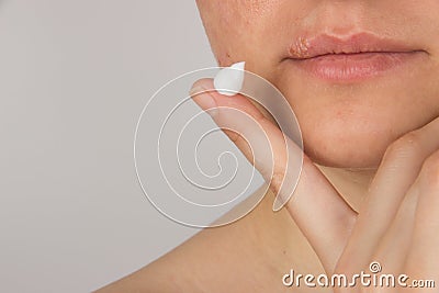 Herpes with pus on the lips of a young girl and pimples on the f Stock Photo