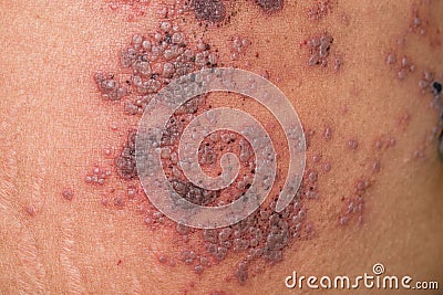 Herpes simplex infection at abdomen. Small and painful vesicles Stock Photo