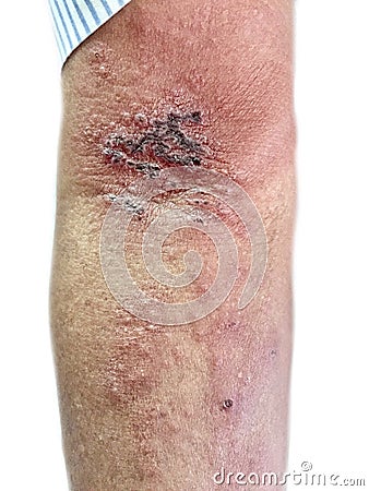 Herpes simplex infection at arm. Small and painful vesicles Stock Photo