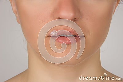 Herpes sore with pus on the lips of the young beautiful girl and Stock Photo