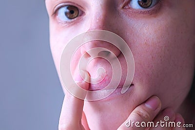 Herpes virus on human lips. Woman with herpes sore on upper lip on mouth. Stock Photo