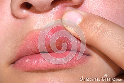 Herpes virus on the lip Stock Photo