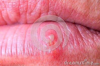 Herpes virus on the lower lip of an adult male close-up Stock Photo