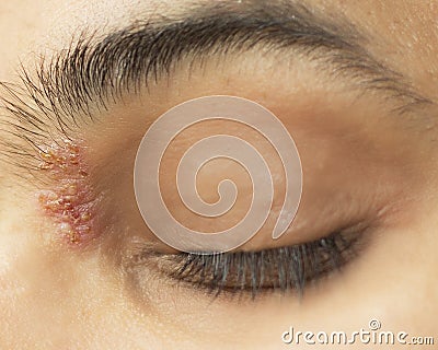 Herpetic eye disease - herpes zoster ophthalmicus Stock Photo