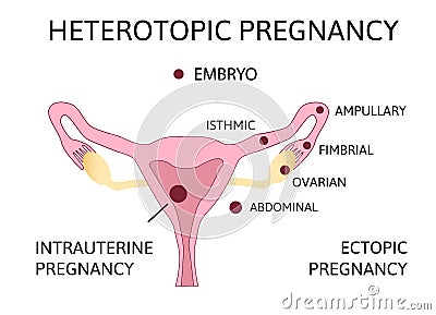 Heterotopic Pregnancy. extra-uterine ectopic pregnancy and intrauterine pregnancy occur simultaneously Stock Photo