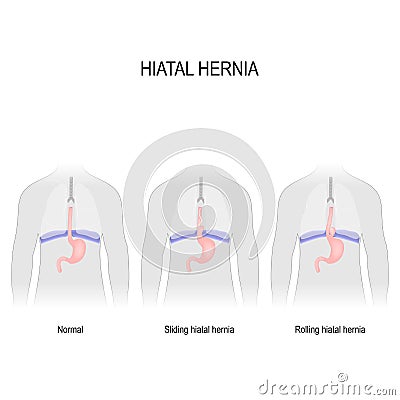 Hiatal hernia Vector Illustration