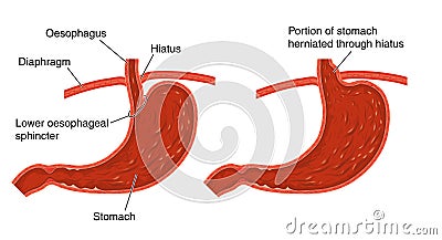 Hiatus hernia Vector Illustration