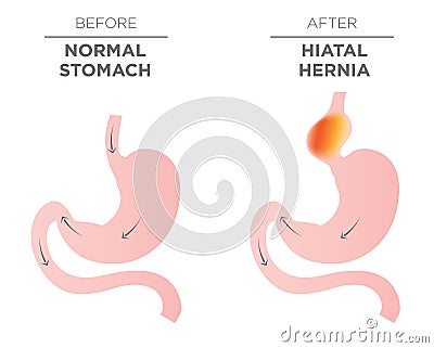 Hiatus Hernia Stomach Image Vector Illustration