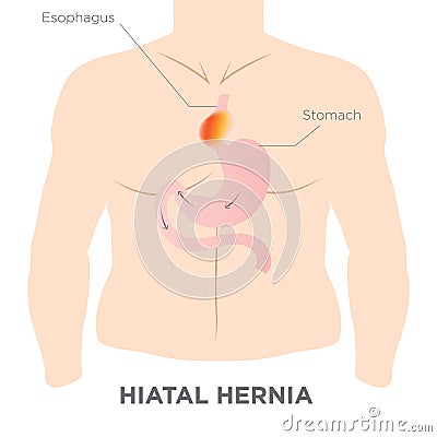 Hiatus Hernia Stomach Image Vector Illustration