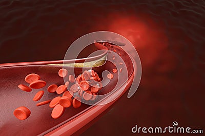 High cholesterol blocked blood cell in artery Stock Photo