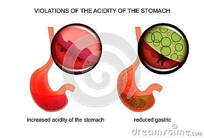 High and low acidity of the stomach Vector Illustration