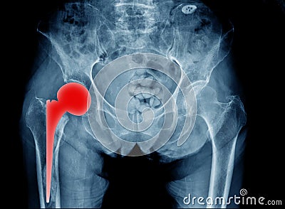 Hip replacement x-ray Stock Photo