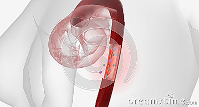 High volumes of lymphocytes, macrophages, and other immune cells infiltrate the inflamed aorta Stock Photo