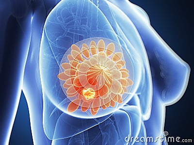 Highlighted breast cancer Cartoon Illustration