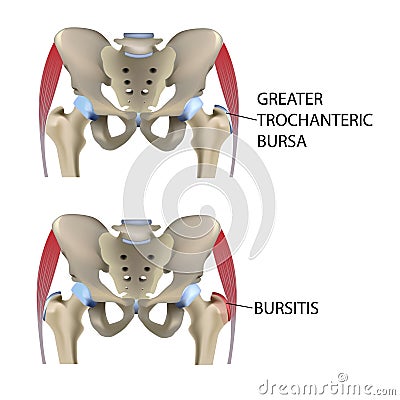 Hip bursitis, vector medical illustration Vector Illustration