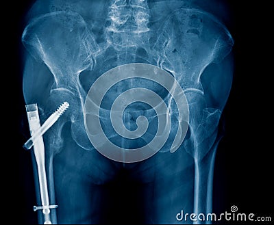 Hip fixation for old patient with hip fracture Stock Photo