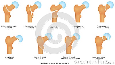 Hip fractures Vector Illustration