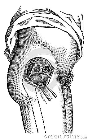 Hip joint opened by the outside, to show the neck of the femur, vintage engraving Vector Illustration