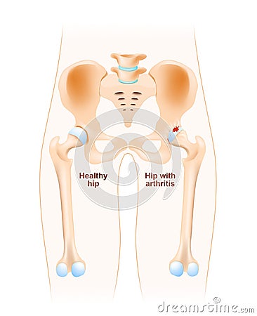 Hip joint with osteoarthritis Vector Illustration