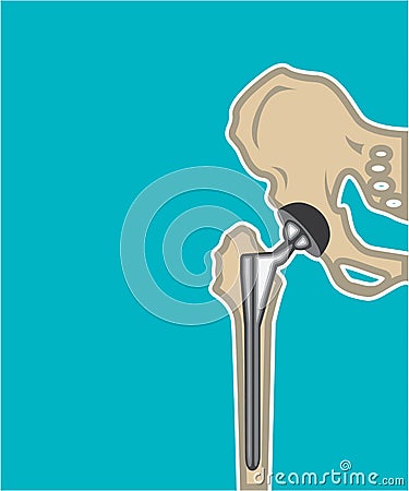 Hip Joint Replacement Vector Illustration