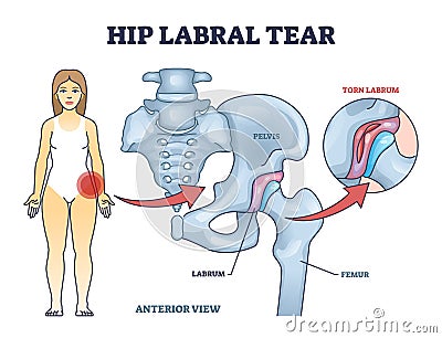 Hip labral tear explanation as medical labrum bone damage outline diagram Vector Illustration