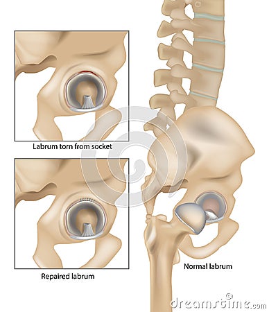 Hip Labral Tears. Labrum torn from socket and Repaired labrum. Surgery for Repairing a Torn Hip Labral Vector Illustration
