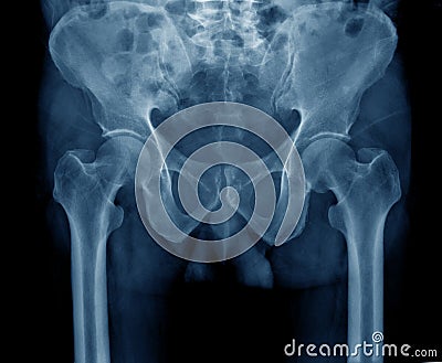 Hip and pelvic bone Stock Photo