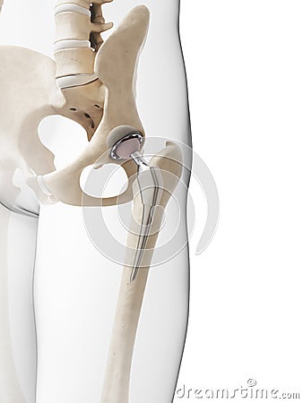 Hip replacement Cartoon Illustration