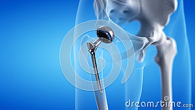 A hip replacement Cartoon Illustration