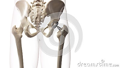 A hip replacement Cartoon Illustration