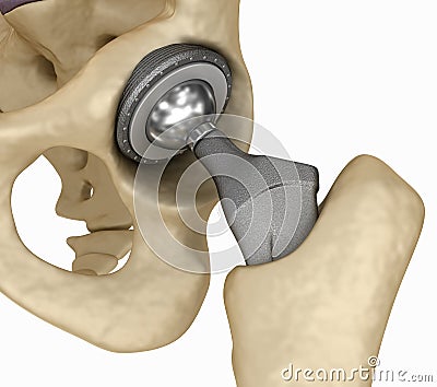 Hip replacement implant installed in the pelvis bone. Cartoon Illustration
