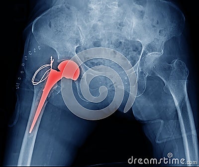 Hip replacement Stock Photo