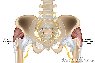 Hip Trochanteric bursitis is inflammation of the bursa. Healthy and inflamed trochanteric bursa. Greater trochanteric Vector Illustration