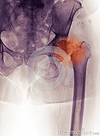 Hip x-ray, fracture and DJD (degenerative joint d) Stock Photo