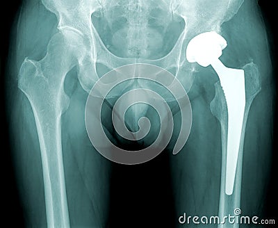 Hip x-ray with replacement of the joint Stock Photo