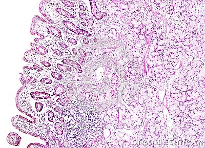 Histology of human tissue, show gastric mucosa intestinal metaplasia as seen under the microscope Stock Photo