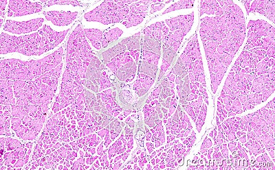 Histology of human tissue, show necrosis of skeletal muscle as seen under the microscope, 10x zoom Stock Photo