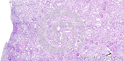 Histology of human tissue, show nephritis as seen under the microscope Stock Photo