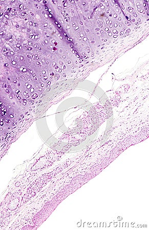 Histology of human tissue, show squamous metaplasia of bronchial mucosa as seen under the microscope, 10x zoom Stock Photo