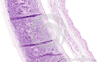 Histology of human tissue, show tracheitis and squamous metaplasia of bronchial mucosa as seen under the microscope Stock Photo