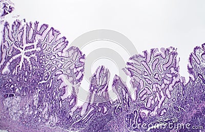 Chronic superficial gastritis, light micrograph Stock Photo