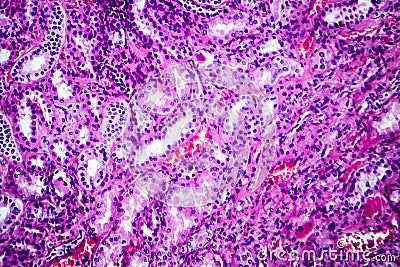 Histopathology of hypertensive renal disease, light micrograph Stock Photo