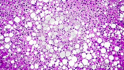 Histopathology of liver steatosis, or fatty liver Stock Photo
