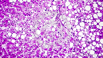 Histopathology of liver steatosis, or fatty liver Stock Photo