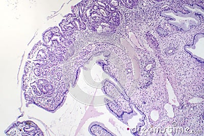 Histopathology of nasal polyps Stock Photo