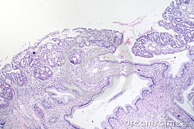 Histopathology of nasal polyps Stock Photo