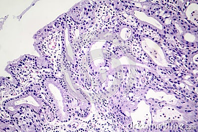 Histopathology of nasal polyps Stock Photo