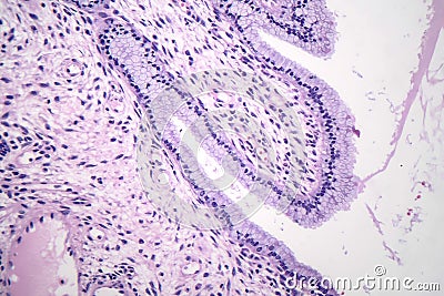 Histopathology of nasal polyps Stock Photo