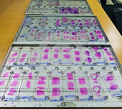Histopathology slides stained with leishman stain, displayed and ready for microscopy Stock Photo